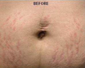Stretch Marks patient before photo
