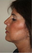 ThermiRF patient after photo