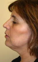 ThermiRF patient before photo