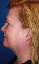 ThermiRF patient before photo