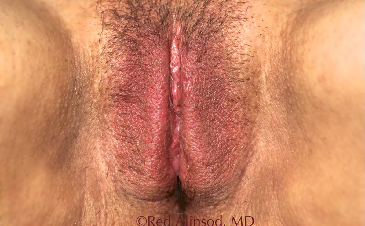 ThermiVA patient after photo