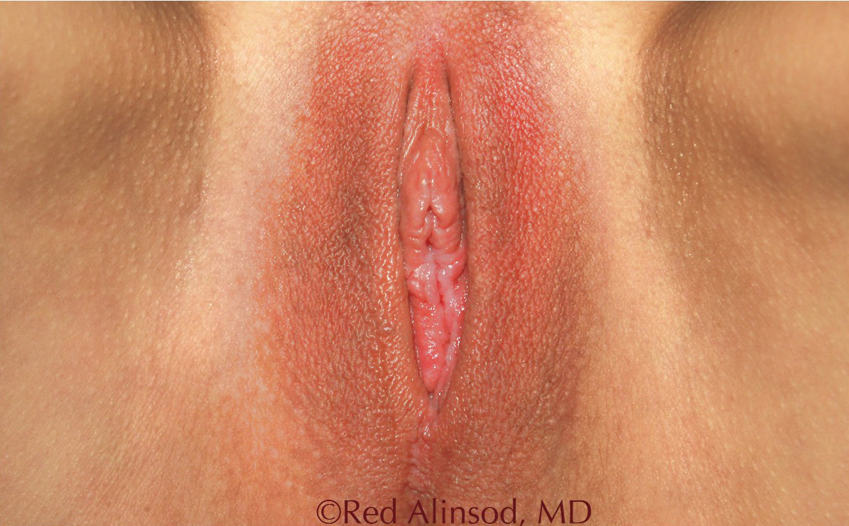 ThermiVA patient after photo