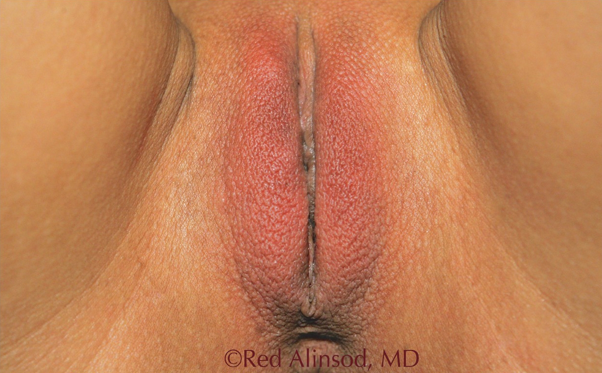 ThermiVA patient after photo