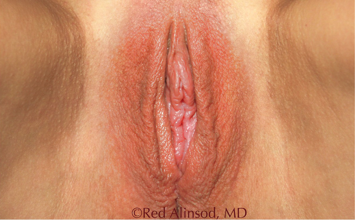 ThermiVA patient before photo
