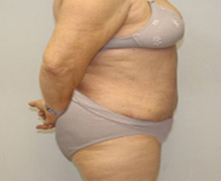 Tummy Tuck patient after photo