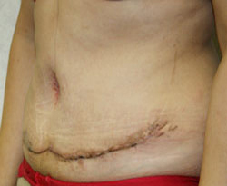 Tummy Tuck patient after photo