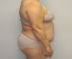 Tummy Tuck patient before photo