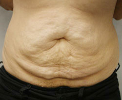 Tummy Tuck patient before photo