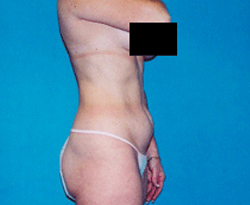 Tummy Tuck patient before photo