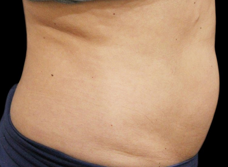 Vanquish Fat Removal Treatment patient after photo