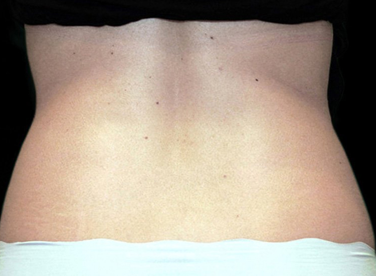 Vanquish Fat Removal Treatment patient after photo