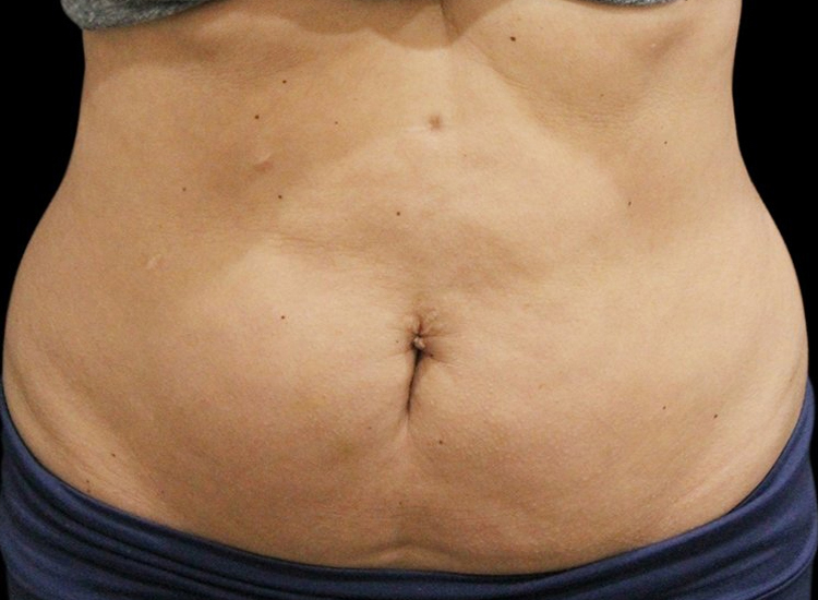 Vanquish Fat Removal Treatment patient after photo