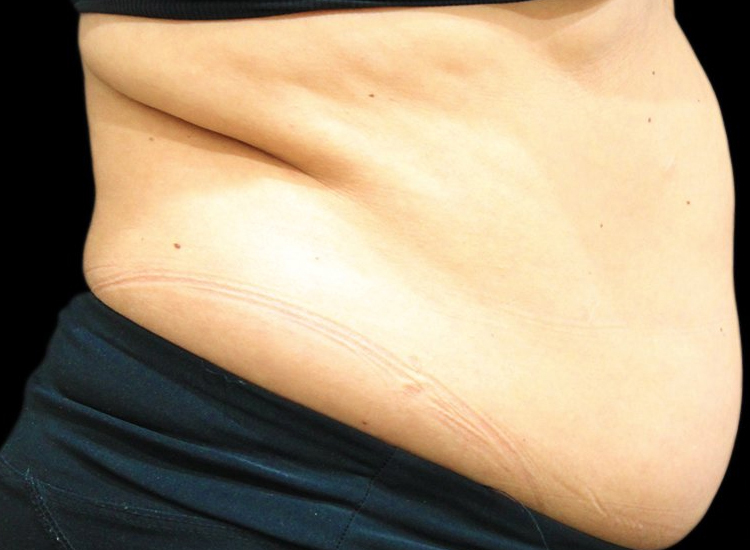 Vanquish Fat Removal Treatment patient before photo