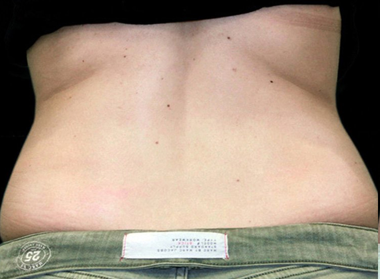 Vanquish Fat Removal Treatment patient before photo