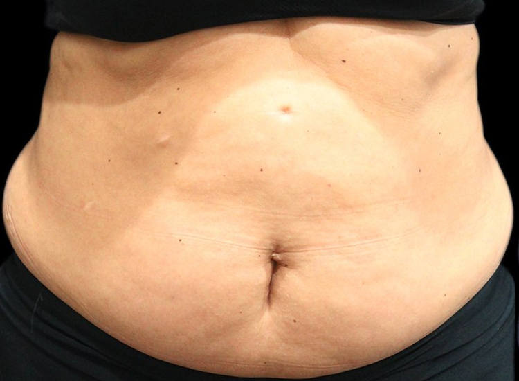 Vanquish Fat Removal Treatment patient before photo