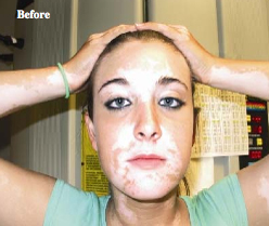 White Spots patient before photo
