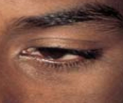 White Spots patient after photo