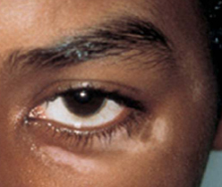 White Spots patient before photo