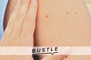 6 Types Of Moles You Should Never Ignore