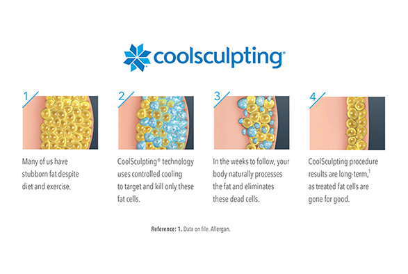 CoolSculpting in Summit, New Jersey Service Photo4