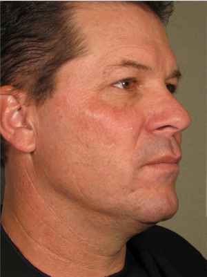 Ultherapy patient after photo