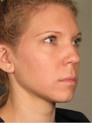 Ultherapy  patient after photo