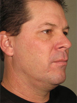 Ultherapy patient before photo