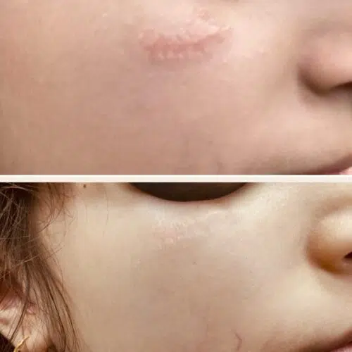 Before & After: DermaV Laser and Microneedling for Scar