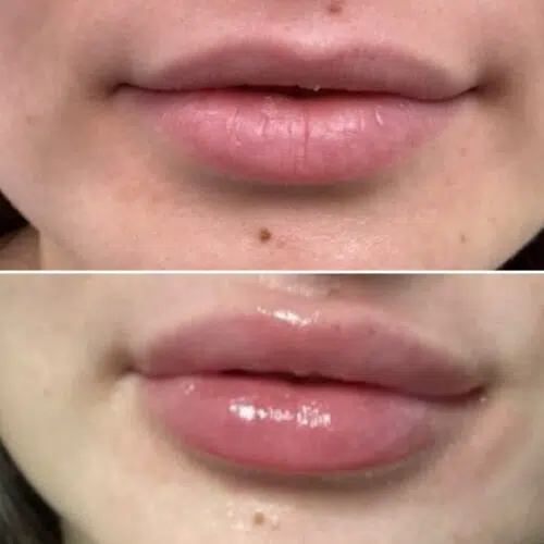 Before & After lips