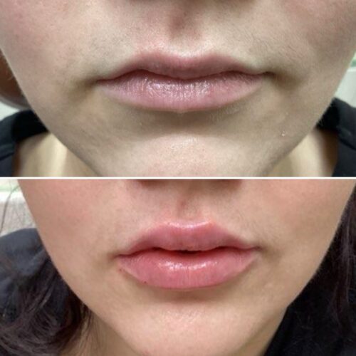 Before & After: Restylane and Redensity Lip Transformation