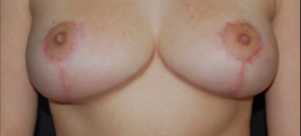 Breast Reduction 1 Separate Page After