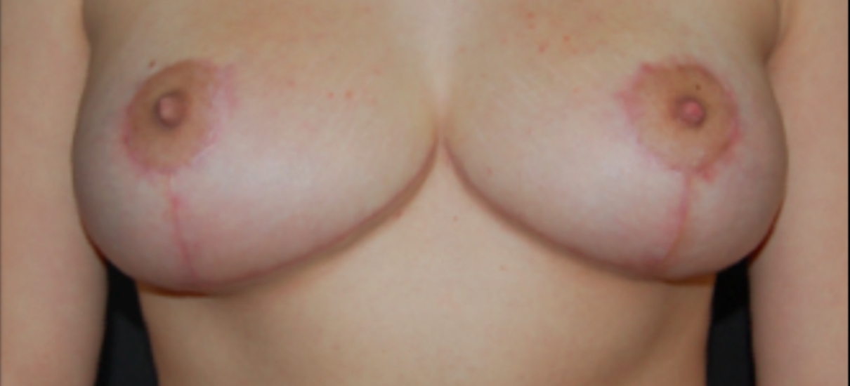 Breast Reduction 1 Patient1 Set1 After