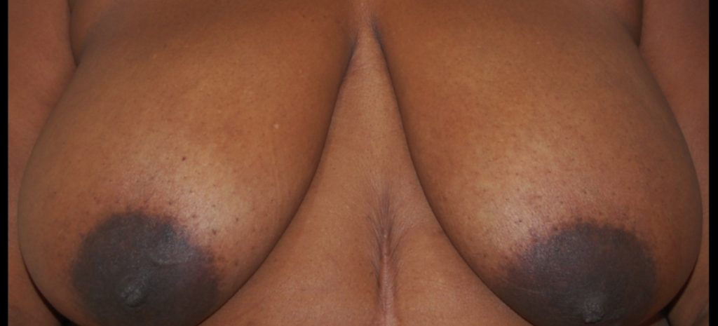 Breast Reduction 4 Separate Page Before