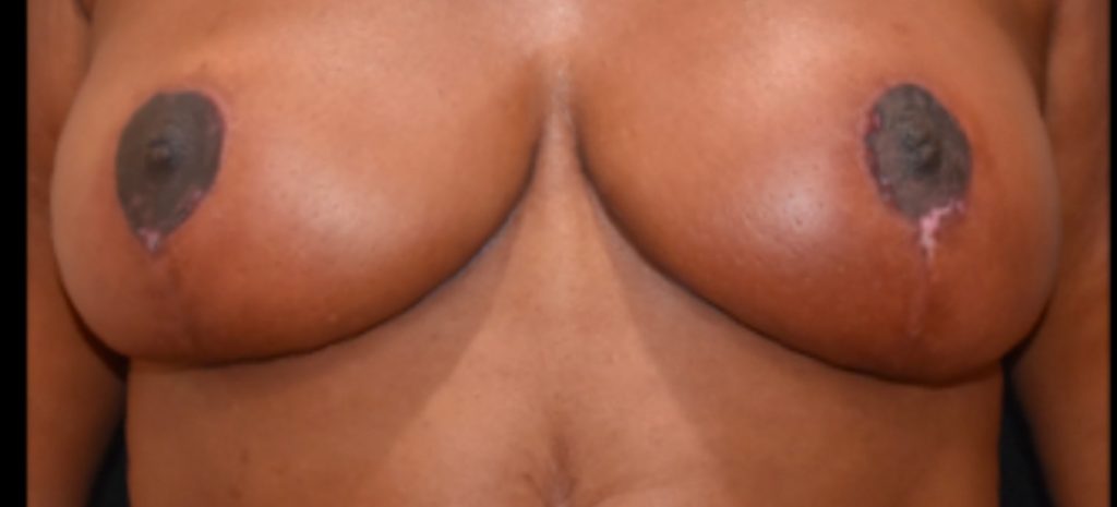 Breast Reduction 4 Separate Page After