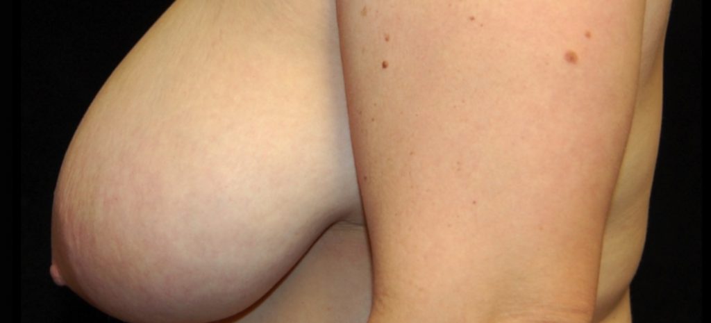 Breast Reduction 8 Separate Page Before