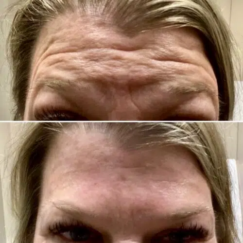 Before & After Forehead