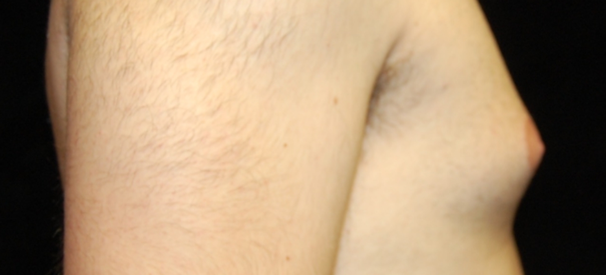 Gynecomasia Excision 1 Patient1 Set1 Before