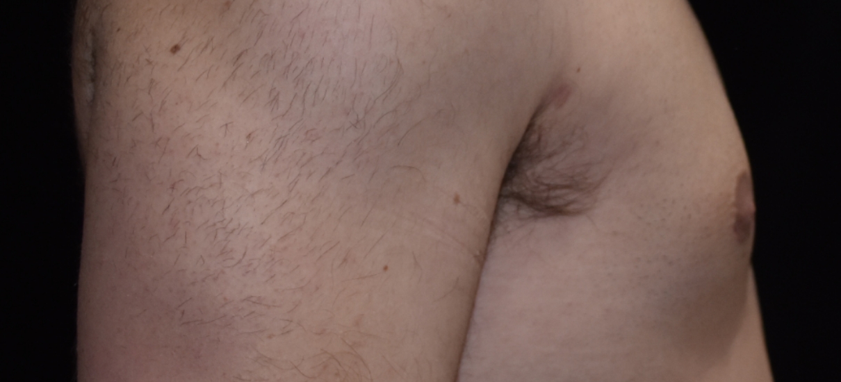 Gynecomasia Excision 1 Patient1 Set1 After