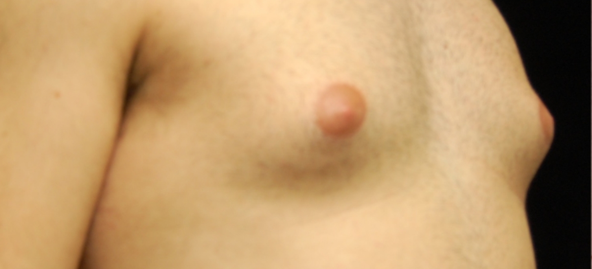 Gynecomasia Excision 2 Patient1 Set1 Before Page