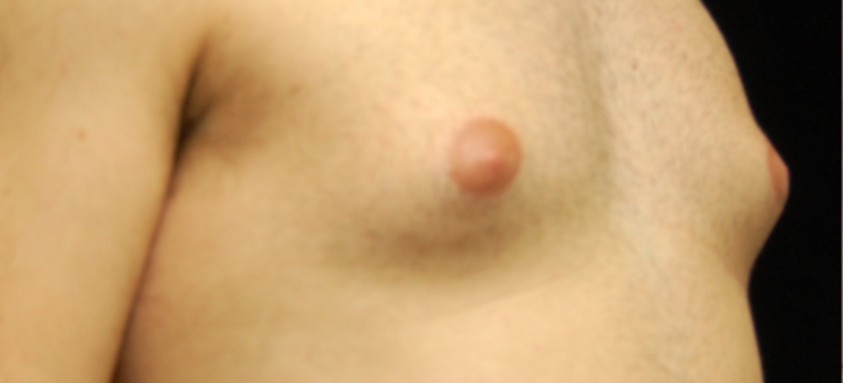 Gynecomasia Excision 2 Patient1 Set1 Before