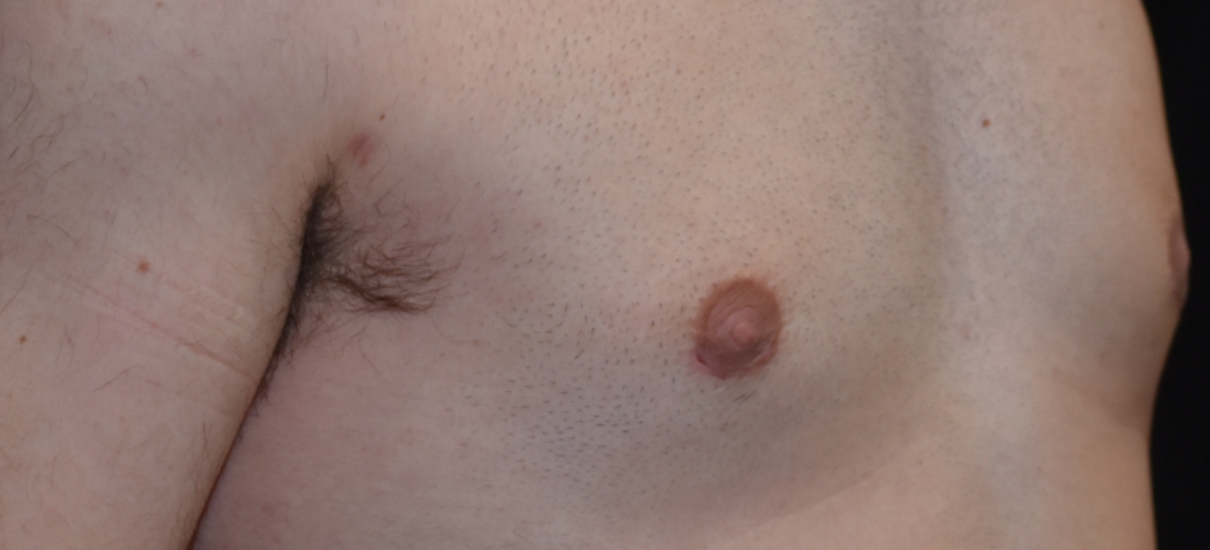 Gynecomasia Excision 2 Patient1 Set1 After