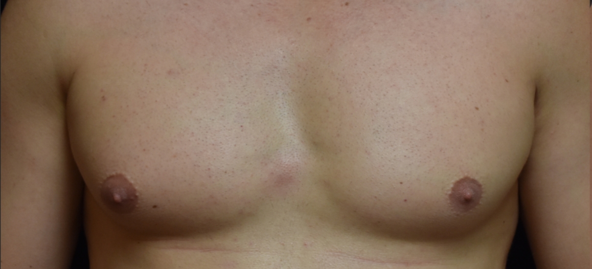 Men – Gynecomastia Service Photo5