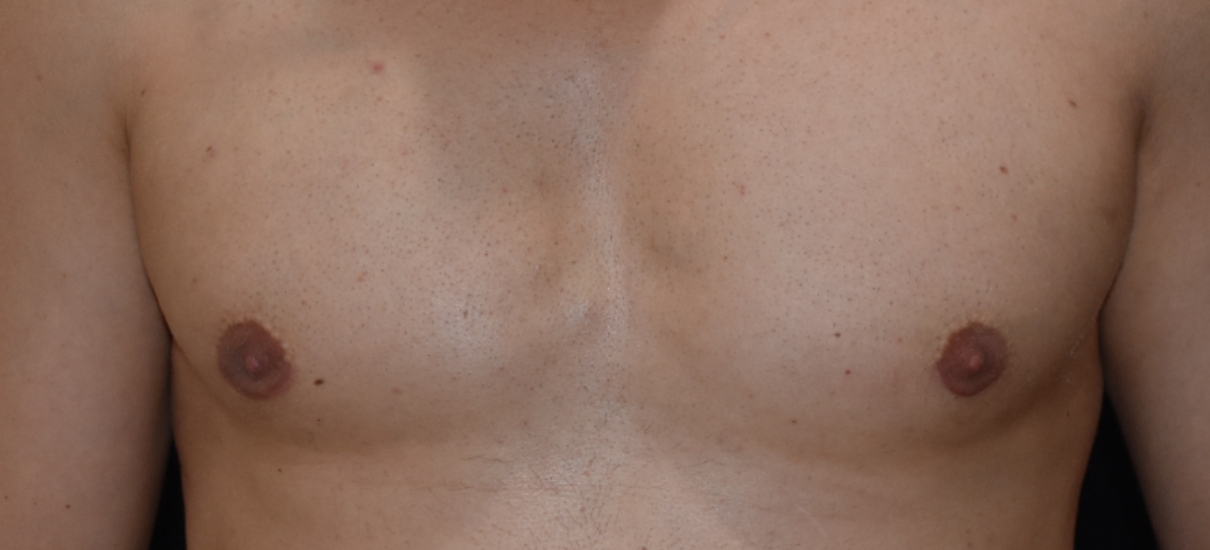 Gynecomasia Excision 3 Patient1 Set1 After
