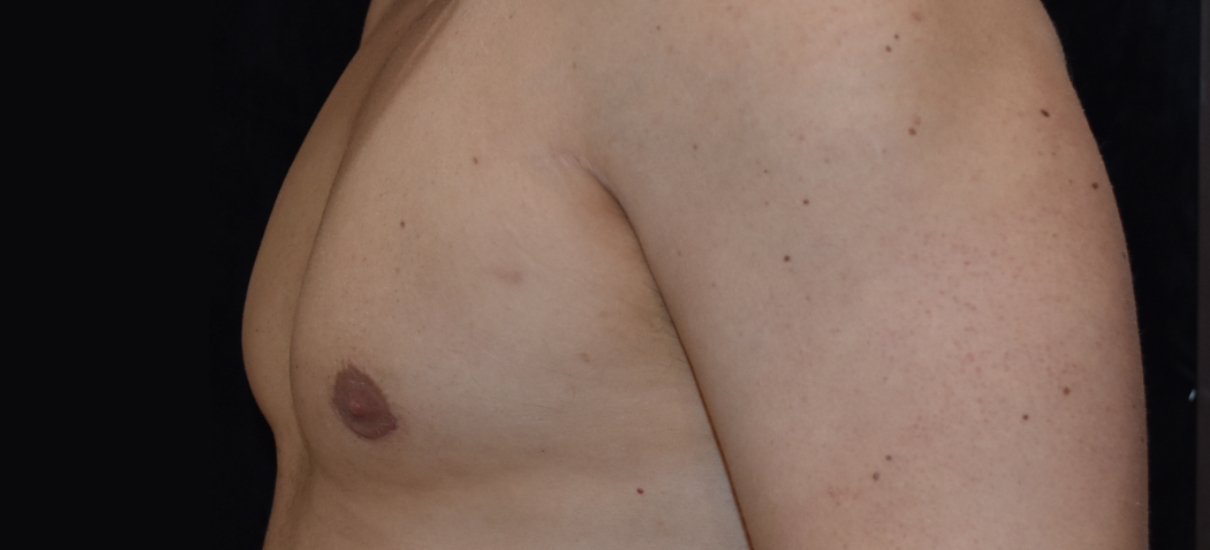 Gynecomasia Excision 4 Patient1 Set1 After Page