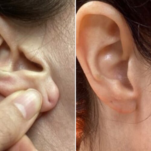 Earlobe Repair
