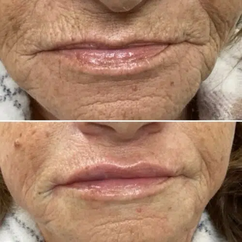 Restylene lip treatment 