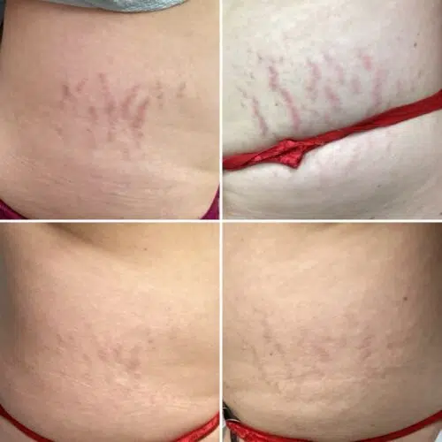 DermaV Laser Treatment