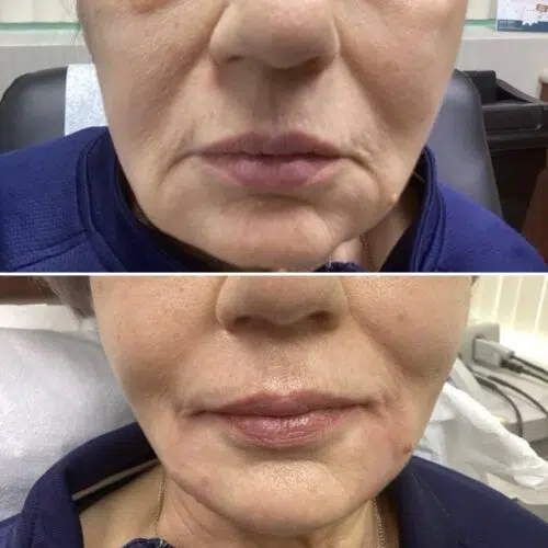 Before & After: Voluma and Volbella Jawline and Corner Mouth Lift