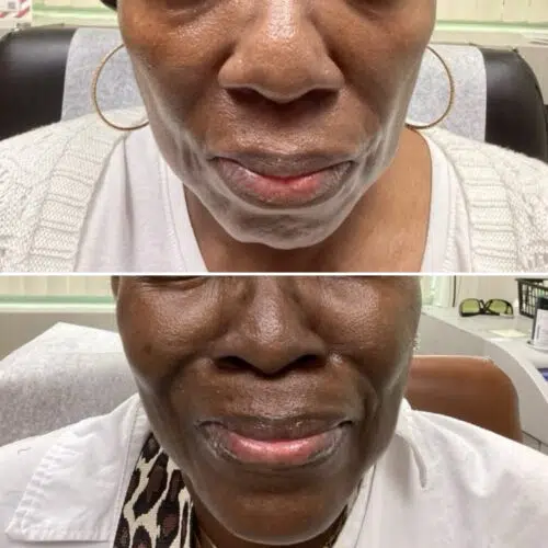 Before & After Cheek Filler
