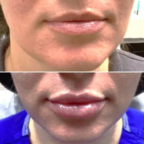 Juvederm Ultra Plus Lip Enhancement